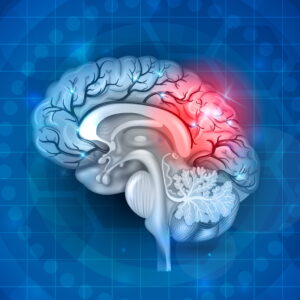 *NEW* Ischemic and Hemorrhagic Stroke: An Overview of Etiology, Symptoms, and Treatment